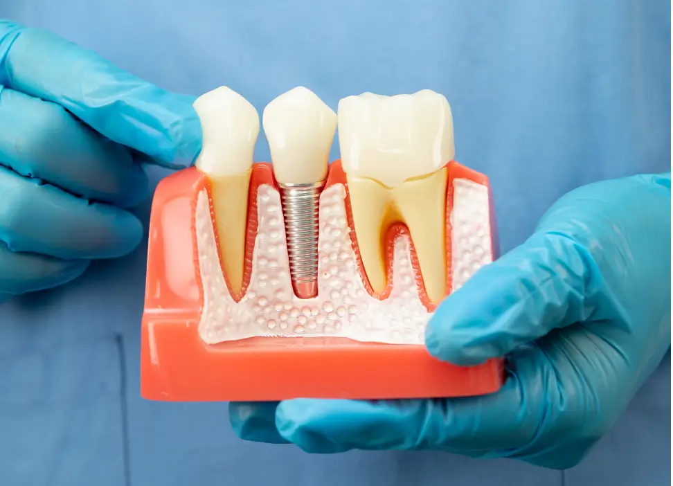 Restorative Dentistry & Implant Dentures at Metro Scott Dental